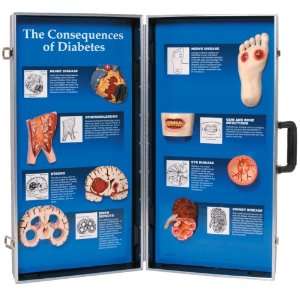 3B Scientific W43081D Consequences of Diabetes 3D Display, 28 Length 